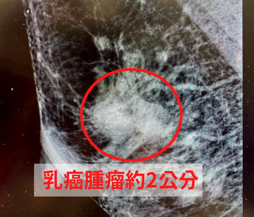 6旬婦「乳頭濕疹」3個月未癒…竟確診罕見乳癌第二期