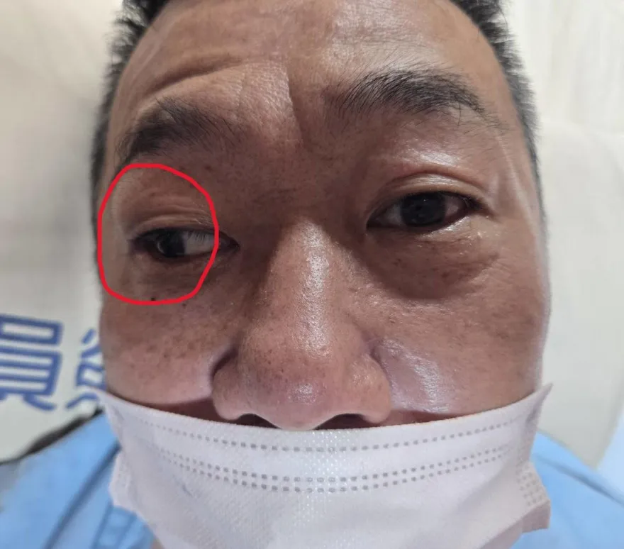 50歲男午睡醒來「右眼無法轉動」！以為中暑竟是腦中風