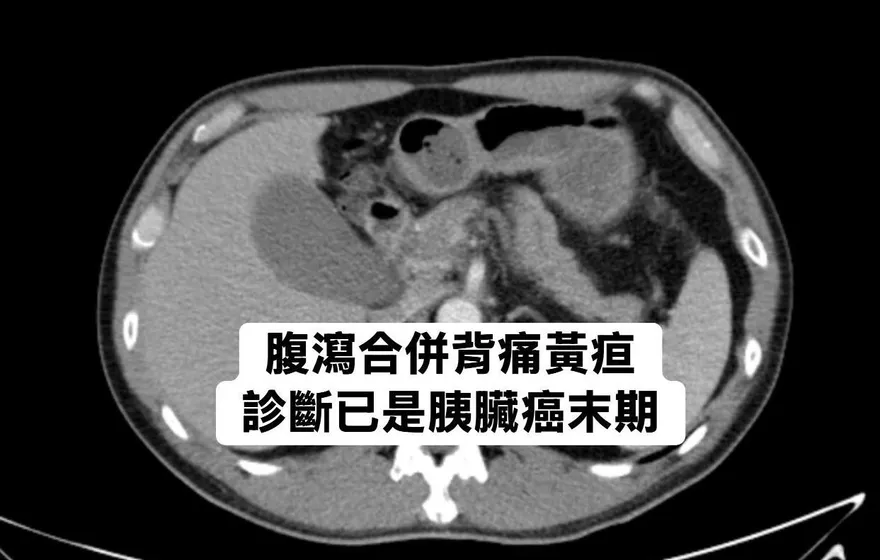 50歲後才得糖尿病要小心！醫：胰臟癌風險是一般人8倍
