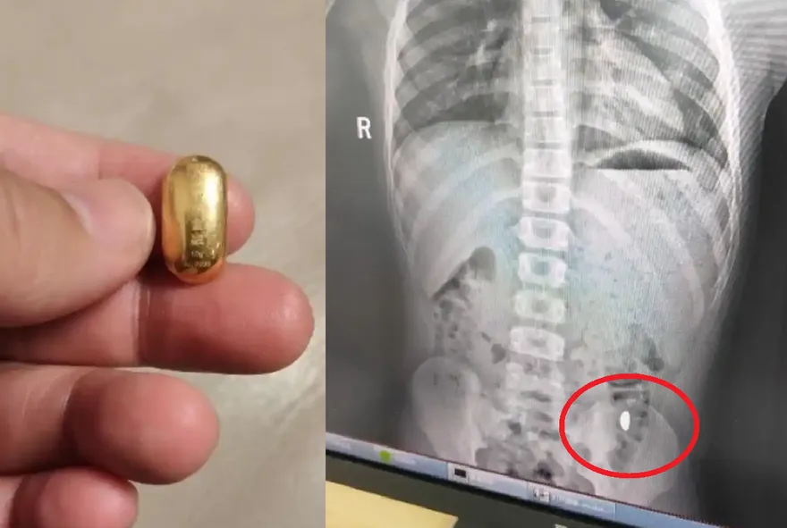 陸熊孩10克金豆吞下肚　媽傻眼禁他「在外解放」5天後終排出