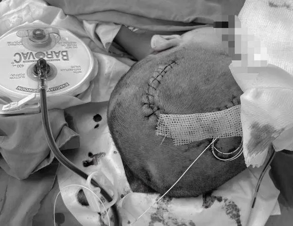 3歲童上鋪摔落「反覆嘔吐」　竟釀腦部大出血！緊急開顱搶命