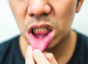 常嘴破小心一病！陸男以為火氣大未重視　反復口腔潰瘍後竟致失明