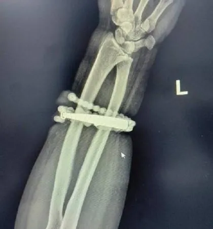 女戴銀手鐲10年未摘「長進肉裡」　醫示警：恐引發敗血症