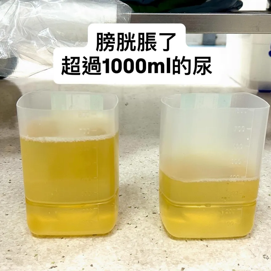 翁漏尿竟因「膀胱塞爆了」！醫：別把求救當意志力測驗