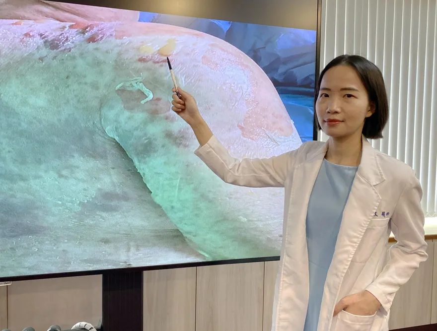 藥物過敏後遺症驚人！研究：罹紅斑性狼瘡機率高近15倍