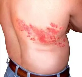 皮蛇纏身如火燒…恐引發永久神經痛！疫苗預防率高達九成