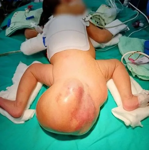 罕見！女嬰帶「16公分大球」出生　重達體重六分之一