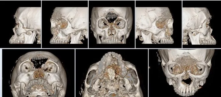 25歲男槍傷致面部粉碎　「虛擬頭骨」3Ｄ列印拼出新臉