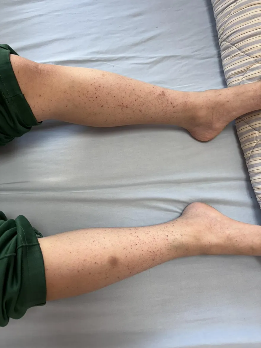 全身冒血點、牙齦流血不止！男童血小板僅剩正常值2%