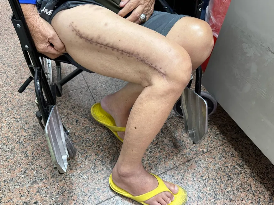 8旬翁大腿骨折三段　三度手術站起：明年要參加媽祖遶境