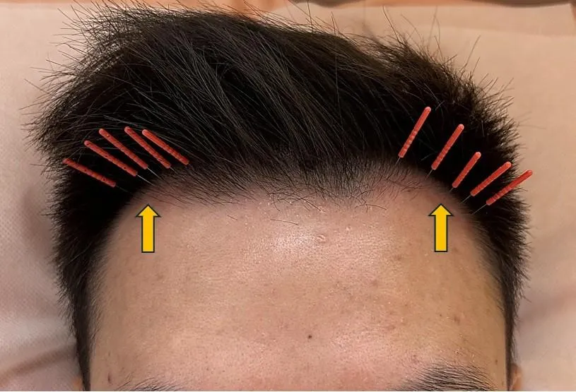 35歲男「M型禿」求助中醫　美顏針治療一個月新生頭髮