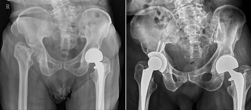 77歲男跌倒只覺臀部痛　「碎骨竟嵌入骨盆」1年後變長短腳