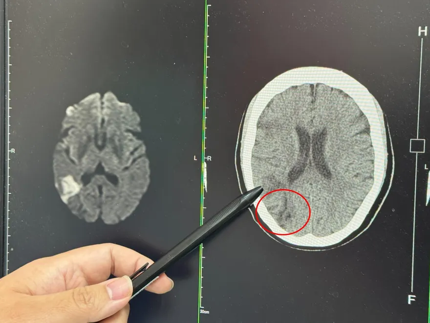 6旬婦「裁縫效率驟降」竟是中風！醫：非典型症狀易被忽略