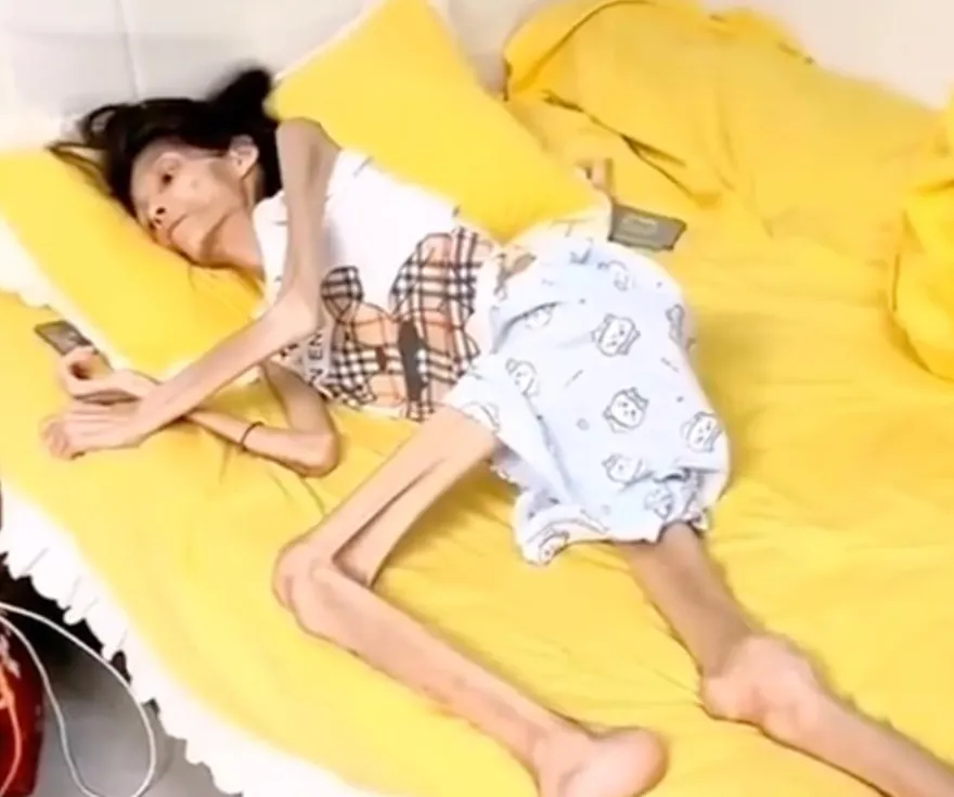 影/瘦到皮包骨！27歲陸女患胃萎縮「體重剩17kg」病逝