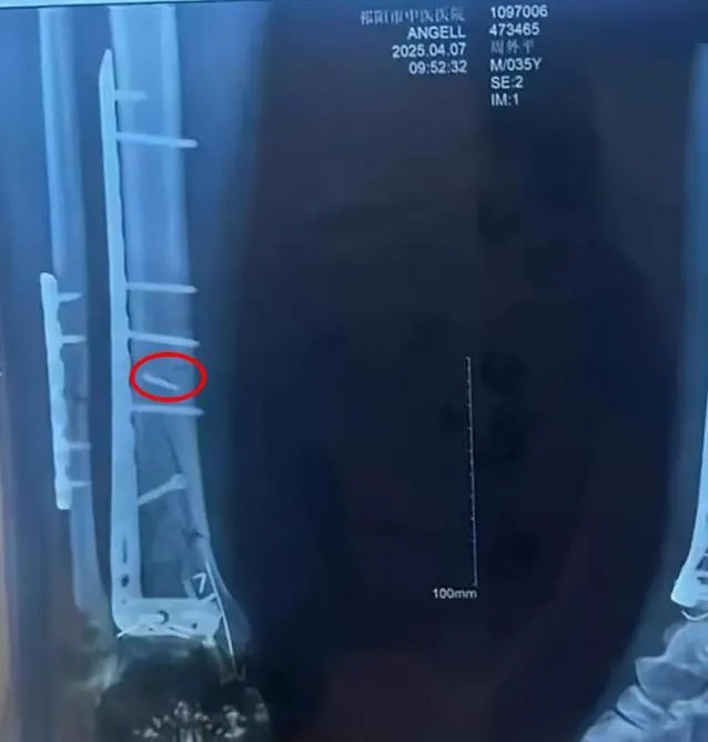 2男同天手術後痛半年...竟因體內留「鑽頭」陸醫扯：影響不大
