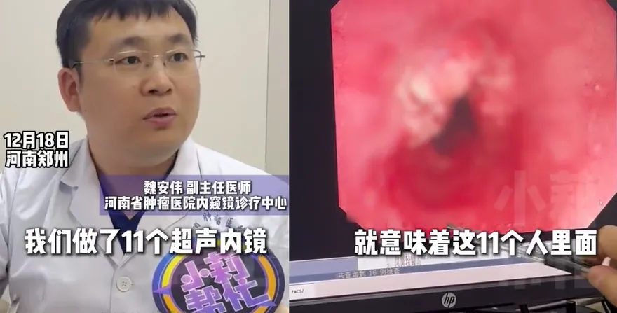 河南醫院一上午「11人確診食道癌晚期」　醫痛心：恐活不過5年