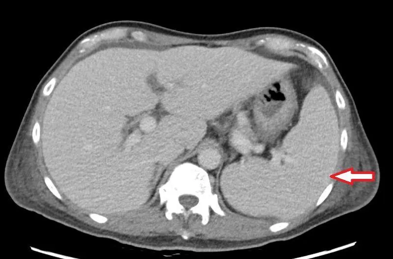 反覆高燒找不到病因！竟是「三尖瓣重度逆流」害脾臟腫大