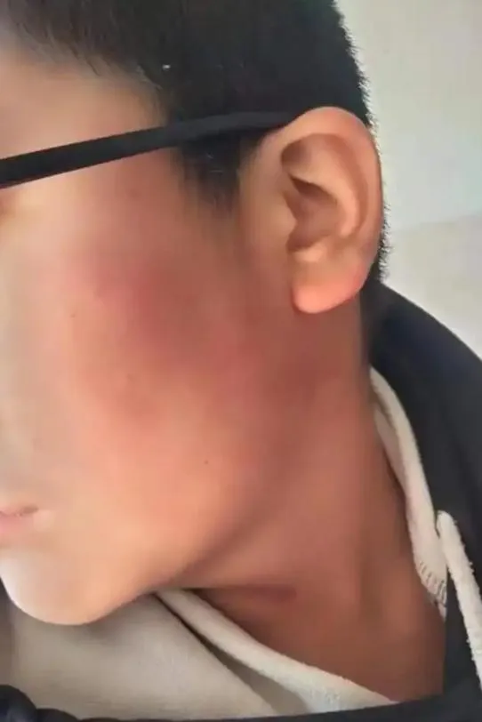 近失明！陸13歲男童遭師掌摑致九級傷殘　校方判賠316萬