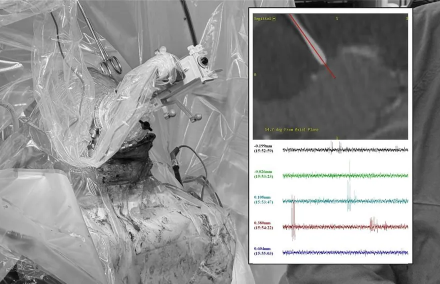 國內首例！台大「深腦刺激系統」植入　緩解男子10年癲癇痛苦