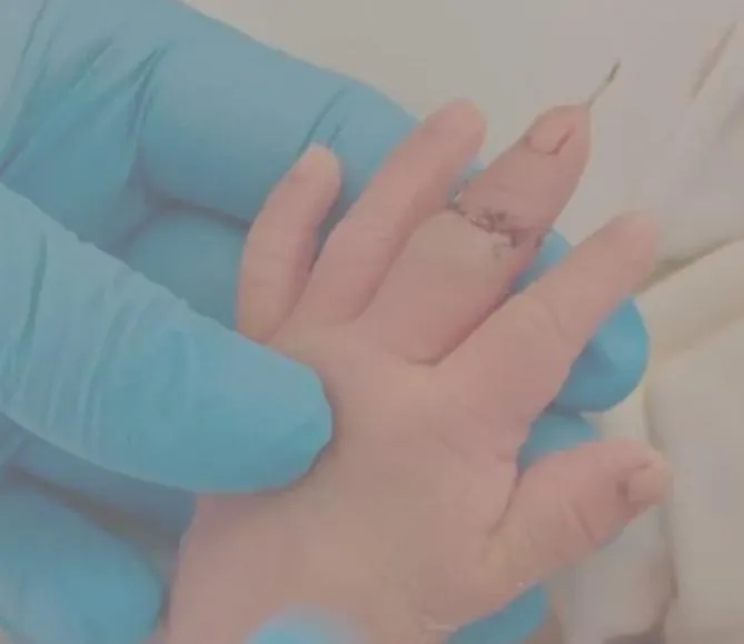 陸醫院剪新生兒臍帶…竟「喀擦」剪斷手指！稱因為「寶寶亂動」