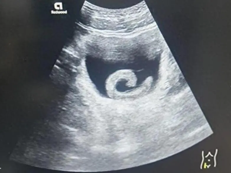 獵奇惹禍！陸男下腹劇痛求診...醫從尿道拉出「5公分水蛭」