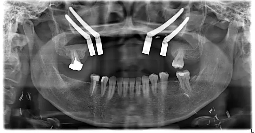 40歲女罹上顎牙齦癌！精準手術當日完成腫瘤切除與植牙