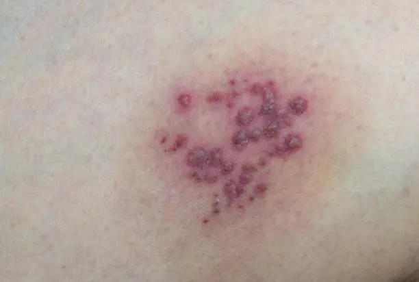 省萬元！皮蛇疫苗補助搶破頭　全台13縣市最新資訊一次看