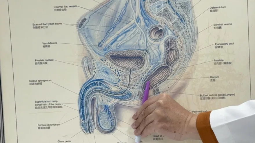 攝護腺術後以為沒事又癌變！超音波消融免開刀助重展雄風
