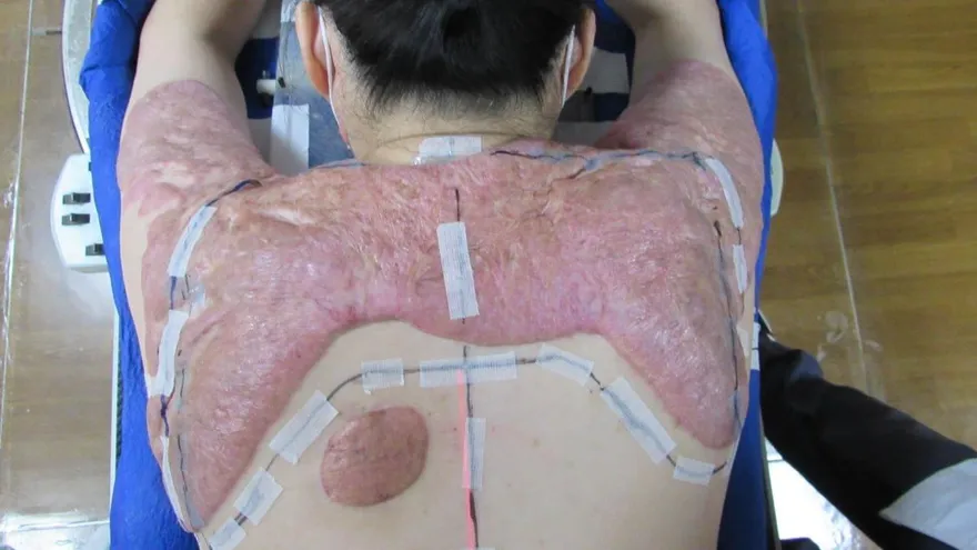 她患蟹足腫30年沒好！痛到每天「只睡2小時」一度想放棄