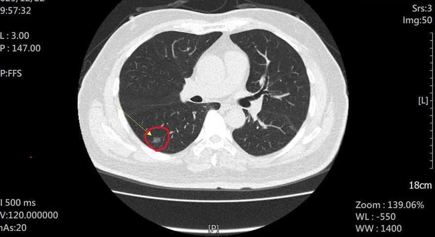 老菸槍為抱孫戒菸！檢查發現「1公分肺腺癌」撿回一命