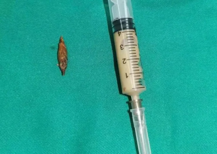 吃八寶飯「誤吞棗核」！6旬陸男卡腸腹脹如孕婦　送醫撿回命