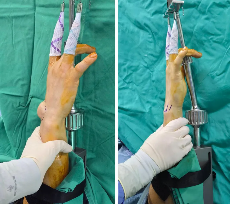 工程師手背驚現「半顆乒乓球」  醫：常打電腦易罹腱鞘囊腫