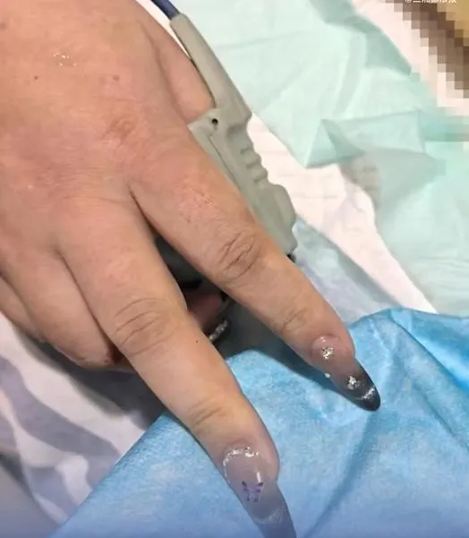 美甲變「隱形殺手」？陸女心臟驟停送醫　指尖「難測血氧」急壞醫