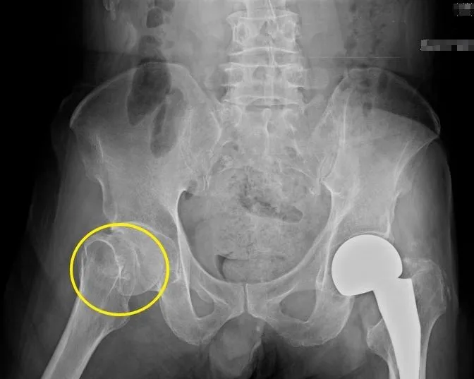 75歲長者跌倒只喊膝蓋痛　一查竟是髖部出問題
