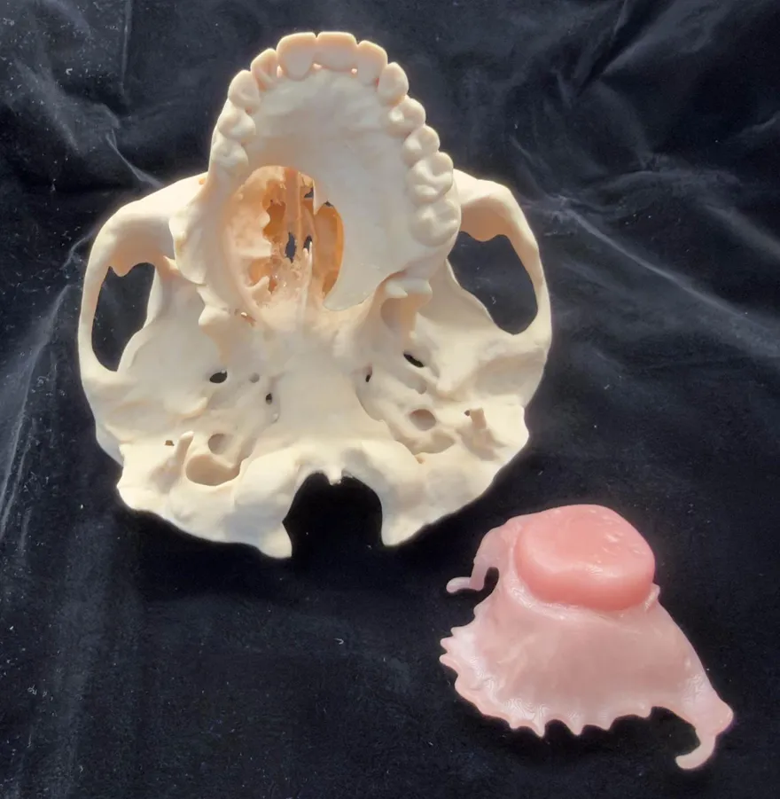 婦插鼻胃管8年不敢出門！長庚「數位閉孔器」解決難題