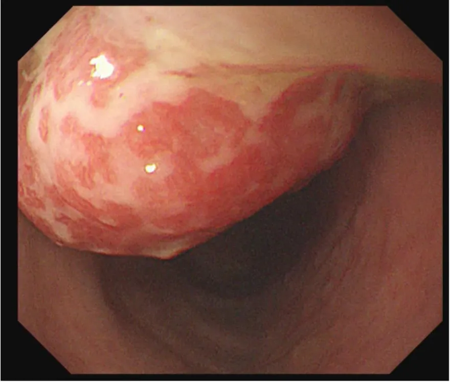 孩子血便吃軟便藥沒改善？醫：反覆鮮紅血便恐是大腸息肉