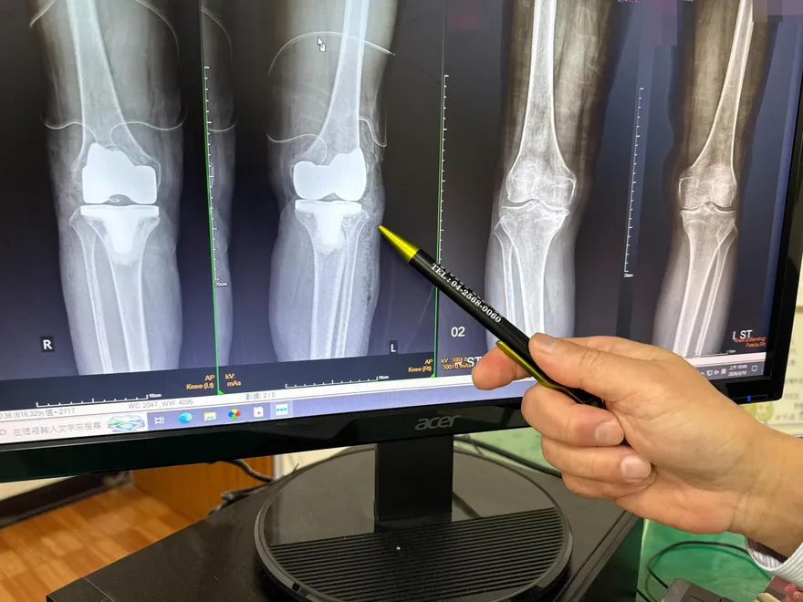 忍痛15年只吃止痛藥！膝蓋退化到跌倒換雙膝才能走