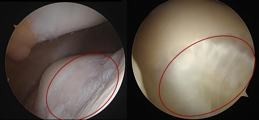 50歲女膝蓋被「挖空」痛到不行　這招讓軟骨神奇長回來！