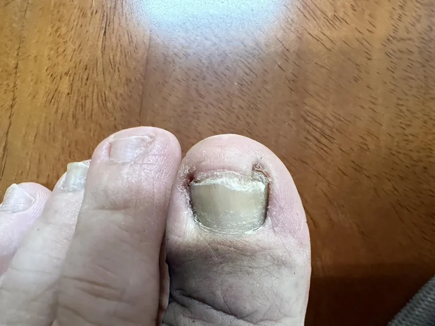 凍甲非小問題！醫警告：拖延恐增生肉芽組織、治療更困難