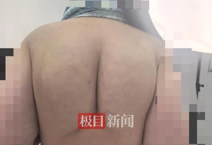 穿塑身衣猛運動！陸女狂瘦25公斤　後背竟「勒」出兩坨硬塊