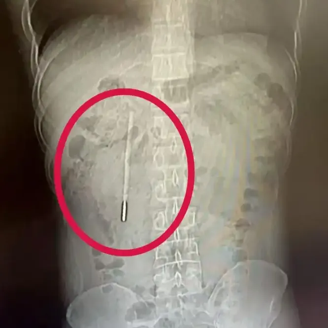 陸男體內藏「水銀體溫計」　12歲時誤吞20年後腹部不適才想起