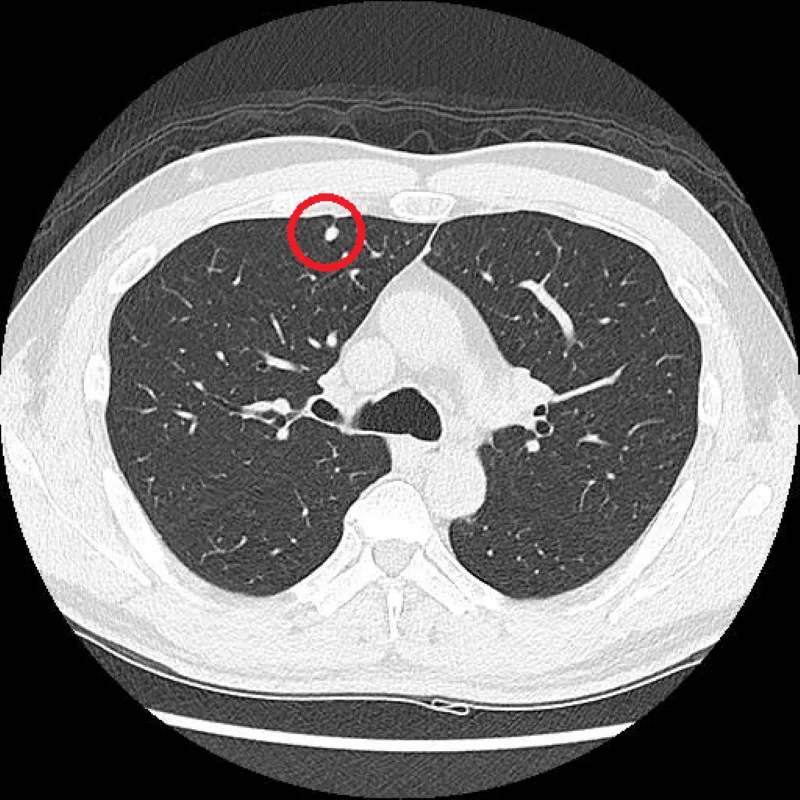 肺癌手術前先「染色」定位！微創切除精準保留更多肺功能