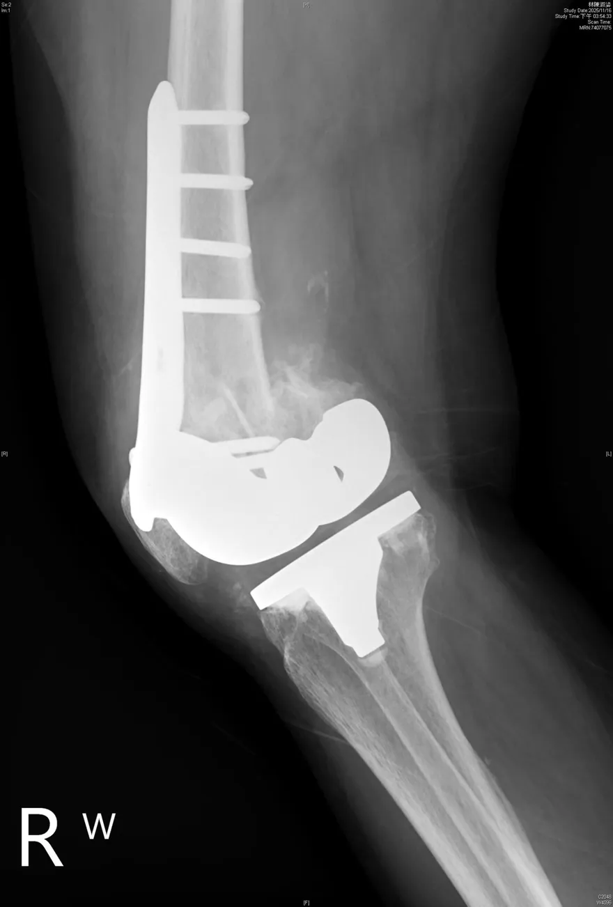 跌一跤膝蓋「啪」一聲！8旬嬤換人工膝關節還是骨折2次