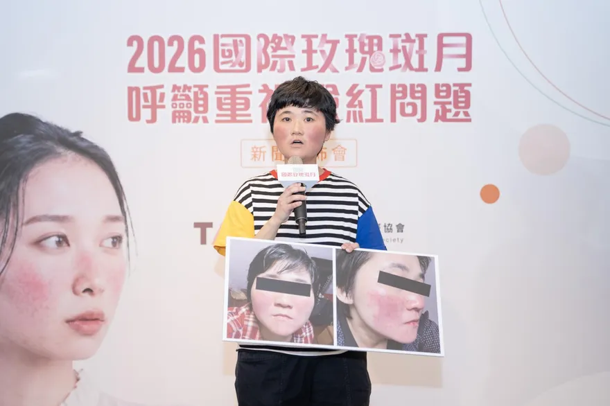 臉紅6年被當異位性皮膚炎！30歲女性確診玫瑰斑　治療後生活品質改善