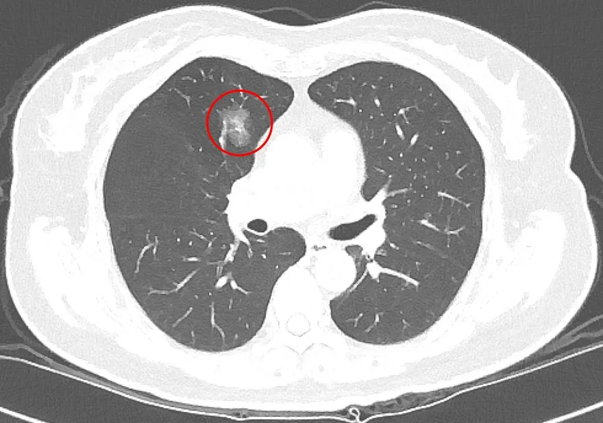 不抽菸也中獎！6旬婦健檢揪「肺結節」追蹤7年確診肺癌