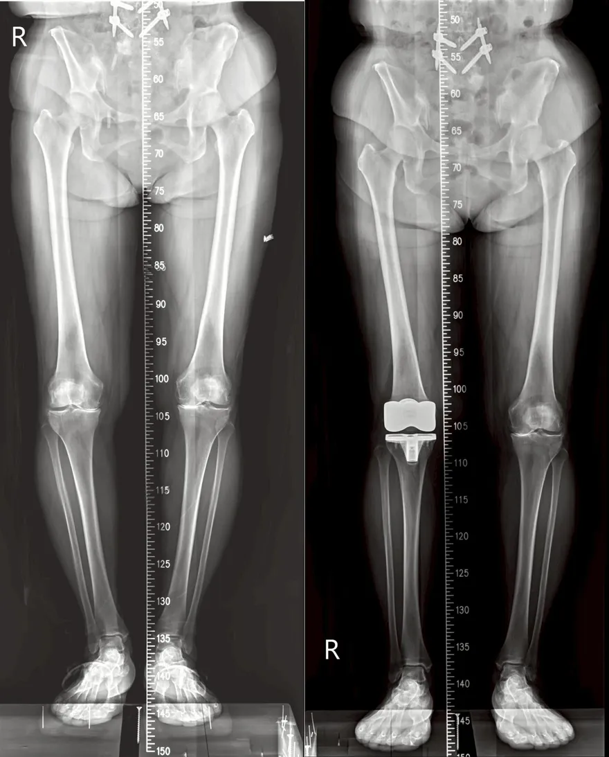 膝蓋磨到骨貼骨！打兩年玻尿酸無效　換人工關節才解決