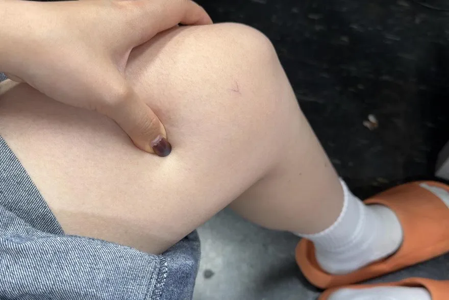 健康我+1/水腫合併「這些症狀」 醫：洗腎、猝死、癌症一起報到！