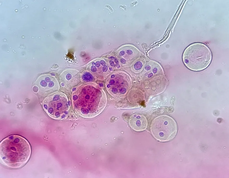 乳癌細胞擴散前先「充電」！醫：粒線體升級是轉移關鍵