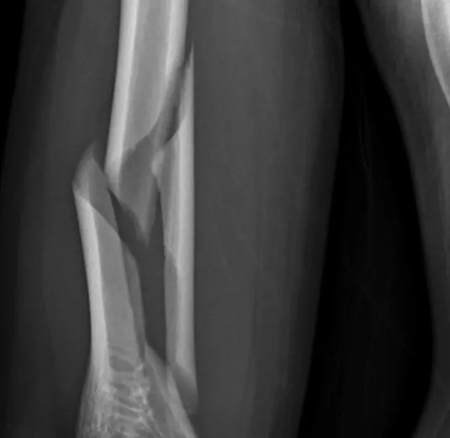 瘦高男注意！他比腕力竟把手臂擰斷　扭轉力比撞擊更傷骨