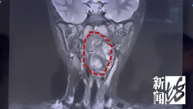 6歲陸童狂打呼！咽喉藏「雞蛋大腫瘤」　醫驚：未發育雙胞胎